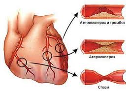 ateroskleroz